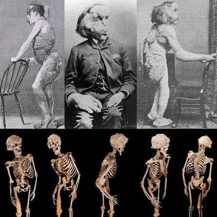 Joseph Carey Merrick nasceu em 5 de agosto de 1862, em Leicester,  Inglaterra. Filho de Mary Jane Potterton e Joseph Rockley Merrick, ele era  o mais velho de três irmãos. Sua infância