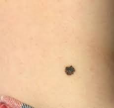 おなかのメラノーマ | 36歳、メラノーマかも