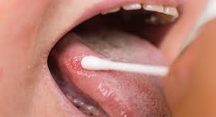 Image result for white cancer on tongue)