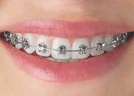 Pendakap gigi jenus clear adalah rm 7,000 hingga rm 9,000. Harga Braces Gigi Dan Kos Pemasangan Pendakap Gigi Ottoman