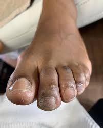 Image result for brown patches on the feet