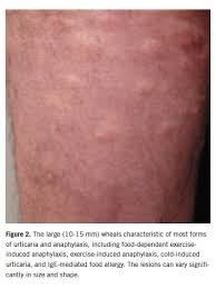 Image result for Exercise-Induced Anaphylaxis