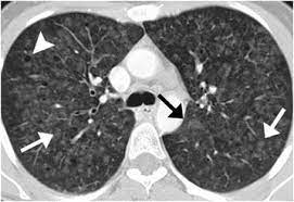 Rbild is defined as respiratory bronchiolitis interstitial lung disease somewhat frequently. Rb Ild In A 44 Year Old Woman With A 20 Pack Year Smoking History Hrct Download Scientific Diagram