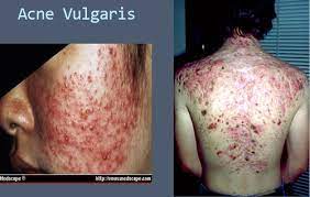 Sebaceous Gland And Hair Follicles Flashcards Quizlet