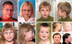 What is kind of expressivity is seen in digeorge syndrome? Systematic Assessment Of Atypical Deletions Reveals Genotype Phenotype Correlation In 22q11 2 Journal Of Medical Genetics