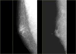 What does a suspicious area look like on a mammogram? The Radiology Assistant Pathology Of The Male Breast