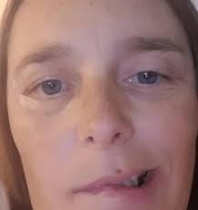 Symptoms of bell's palsy reflect the paralysis of the affected muscles. Bell S Palsy Brisbane Laser Is A Game Changer For Bell S Palsy Treatment
