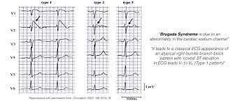 Brugada Syndrome Melbourne Heart Rhythm