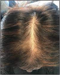 Thanks a lot for visiting my blog and trusthope you find some. Female Pattern Hair Loss A Clinical Pathophysiologic And Therapeutic Review Sciencedirect