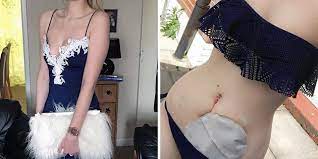 Crohn S Disease Sufferer Proudly Shows Off Colostomy Bag In Bikini Photos Huffpost Australia Life