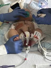 Update* My Sons Berlin Heart(LVAD) : rmedizzy