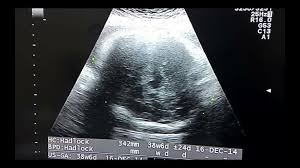 Pin Di Usg Kak Nayla Selama Hamil Yang Dulu