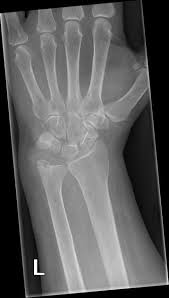 Gout Of Ulnar Styloid Radiology Case Radiopaedia Org Gout Gout Flare Up How To Cure Gout