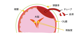 慢性硬膜下血腫とは ～「治る」認知症って？～ | 総合東京病院【公式】中野区 練馬区 24時間救急受入