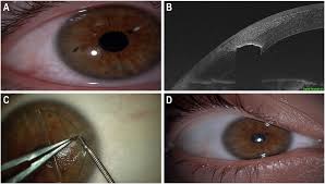Image result for Eye Foreign Body