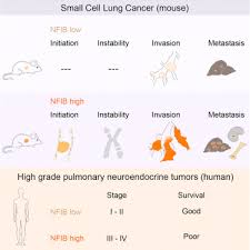 The stages of lung cancer are indicated by roman numerals that range from 0 to iv, with the lowest stages indicating cancer that is limited to the lung. Transcription Factor Nfib Is A Driver Of Small Cell Lung Cancer Progression In Mice And Marks Metastatic Disease In Patients Sciencedirect