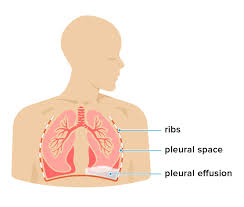 Lungs are sacks of tissue located just below the rib cage and above the diaphragm. Fluid In The Chest Pleural Effusion