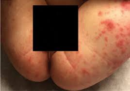 Since your rash is either on your arm, hands or occasionally behind you knee, you can, quite safely, rule out herpes. Blistering Rash In A 1 Year Old Boy