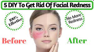 Natural Tips To Get Rid Of Facial Redness | How To Cure Red, Irritated Skin  | Avni - Youtube
