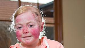 Eliza Baird's painful battle with epidermolysis bullosa