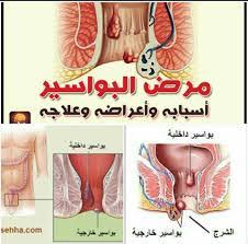 علاج البواسير و الشرخ و الناصور بدون عملية جراحية و بدون ألم Publications Facebook
