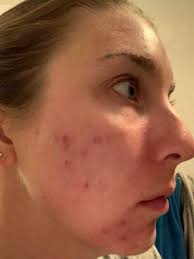 Does acne treatment burn sensitive skin easily?