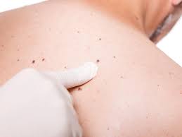 The journal of ethnopharmacology showed that aloe vera gel is beneficial for treating wound and skin. This Man S Skin Tag Turned Out To Be Skin Cancer Allure