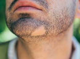 Beard Burn: Treatment And Prevention
