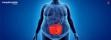 Image result for Obesity