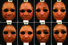 Clinical images from each group in D1/D60. (a and b): control group, (c... 