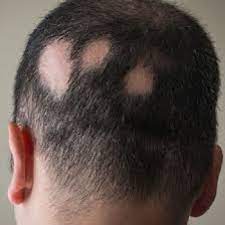 The level of hair loss though will be dependent on some very key factors. Alopecia Areata George Dermatology