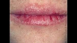 How do you treat a busted lip that is very swollen? Huge Busted Lip Busted Lip Healing How To Treat A Cut Lip Youtube