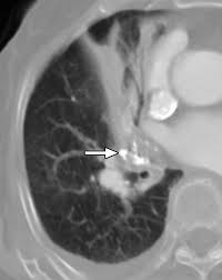 Image result for Broncholithiasis