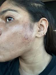 Dr Roostaeian sees a patient with a faical birthmark that's grown out of  control #AboutFace