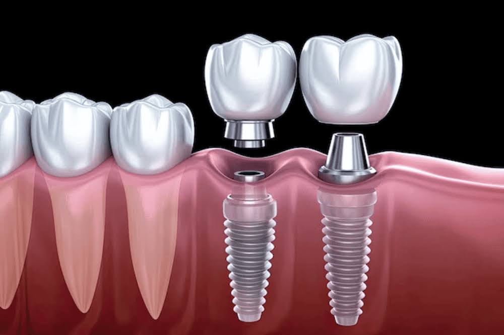 DENTAL IMPLANT product image