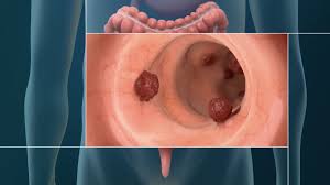 The average age of a colorectal cancer diagnosis for someone with lynch syndrome can occur decades below the. Colon Cancer Causes Symptoms Treatment Options Mercy Medical Baltimore Md