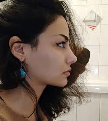 Short Term results mean NOTHING. Left is 5 months post surgery and right is  2,5 YEARS after. It got so much worse over time.