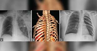 Image result for Flail Chest