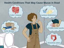 Irritable Bowel Syndrome And Mucus In Your Stool