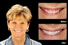 Slider-Test-Final — Best Cosmetic Dentist, Susan Hollar, FAACD, DDS —  Arlington, DFW TX — Restoring Natural Beauty