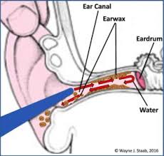 One method is to use a dropper to insert mineral oil, baby oil, or. Earwax Treatment And Removal Getting The Gunk Out