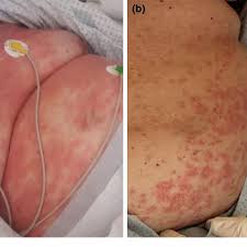 Rashes have a variety of causes, including allergies, infections, and certain other diseases. Skin Manifestations In Covid 19 Patients A Pomphoid Skin Rash Confined Download Scientific Diagram