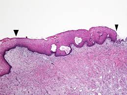There are two types of cells that line the cervix, one lines the outer cervix (portio) and another lines the inner cervix (endocervix). Pathology Outlines Squamous Metaplasia
