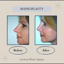 Malcolm A. Lesavoy, MD, FACS