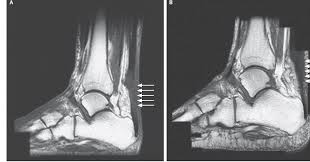 Il tendine d'achille, noto anche come tendine achilleo o tendine calcaneale, è un tendine posteriore della gamba. Trattamento Riabilitativo Dopo Rottura Del Tendine D Achille Programma Completo Taping Kinesiologico Massaggio Trasverso Profondo
