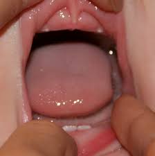 Image result for Neonatal Teeth
