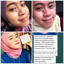 Bagi siapa saja yang tidak menyukai tahi lalat bisa dihilangkan dengan mudah. Set Lengkap Rev Ubat Buang Tahi Lalat Ketuat Kutil Dan Biji Kolesterol Shopee Malaysia