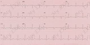 Image result for Q Wave