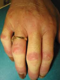 Image result for Connective Tissue Disorder