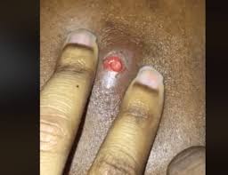 Do not extract ingrown hairs but if your mind is set on a smooth bikini line, don't let the threat of bumps stand in your way. Giant Ingrown Hair On Bikini Line Ingrown Hair